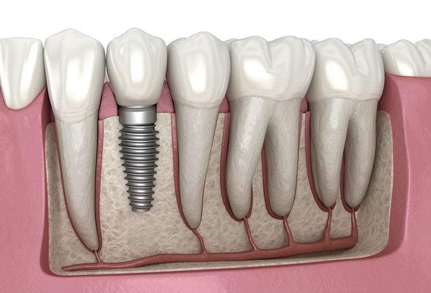 Implantul dentar – ce este bine sa stii inainte de a te decide sa optezi pentru unul?